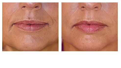 juvederm-02.jpg juvederm-02.jpg